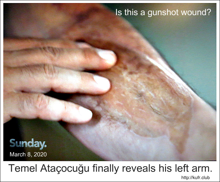 Temel finally reveals left arm